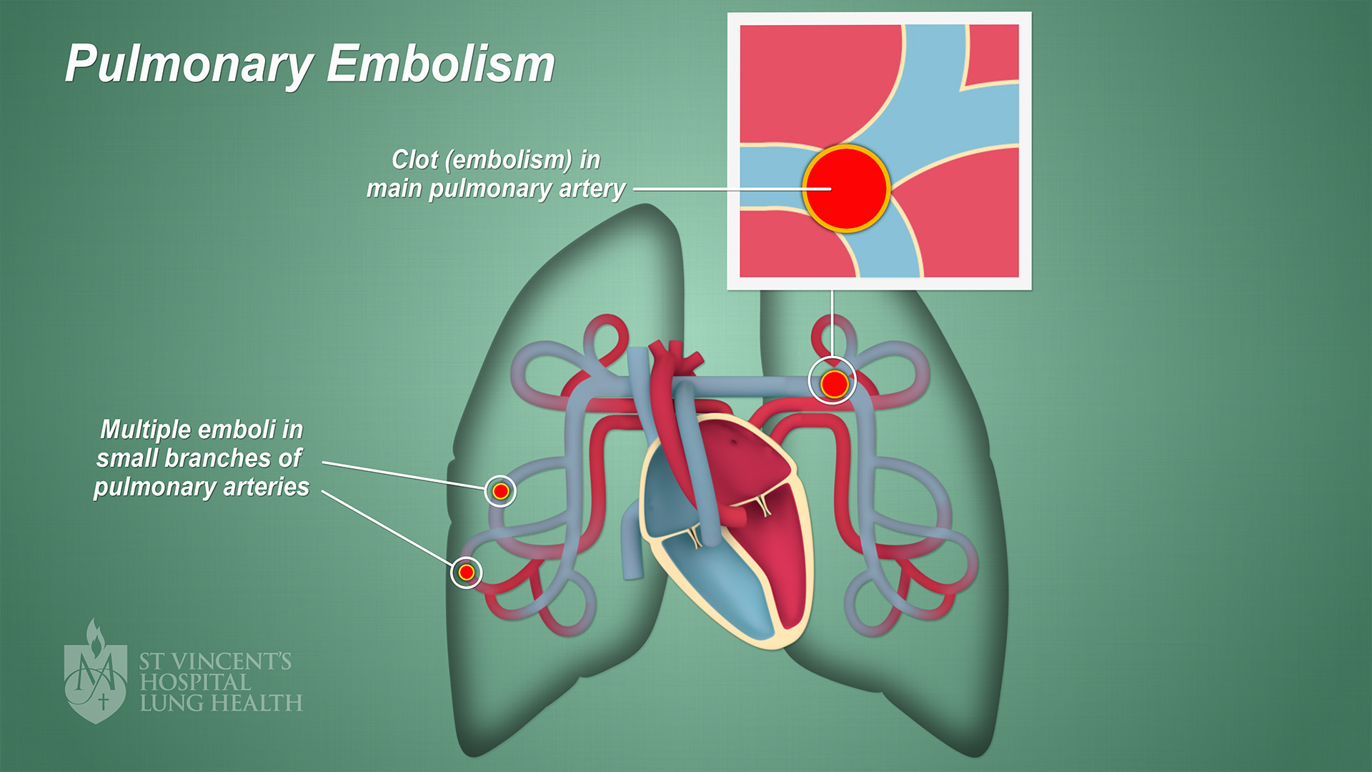 Pulmonary Embolism Types
