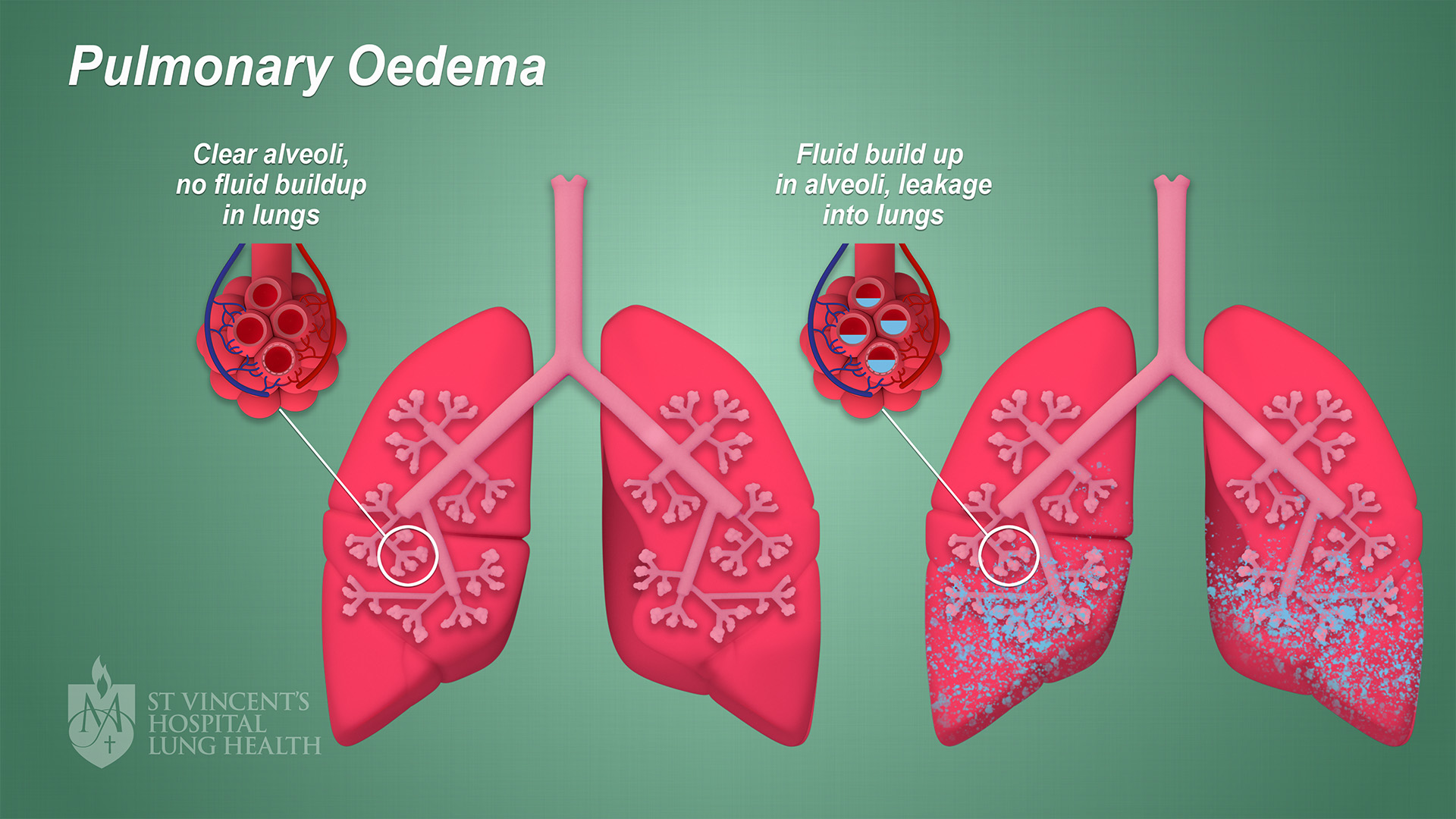 Describe The Skin Of A Person With Pulmonary Edema ElysekruwTyler